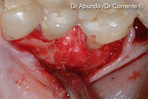 periodontal_regeneration_on_3.65